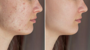 Minor scars Before & after Treatment images in South Jordan, UT | SkinLumi Aesthetics