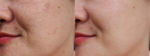 Enhances the texture of the skin Before & after Treatment images in South Jordan, UT | SkinLumi Aesthetics
