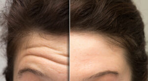 Horizontal Forehead lines Before & after Treatment images in South Jordan, UT | SkinLumi Aesthetics