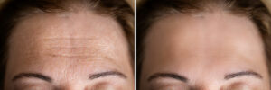 Improves the appearance of wrinkles​ Before & after Treatment images in South Jordan, UT | SkinLumi Aesthetics