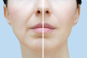 Lip_lines Before & after Treatment images in South Jordan, UT | SkinLumi Aesthetics