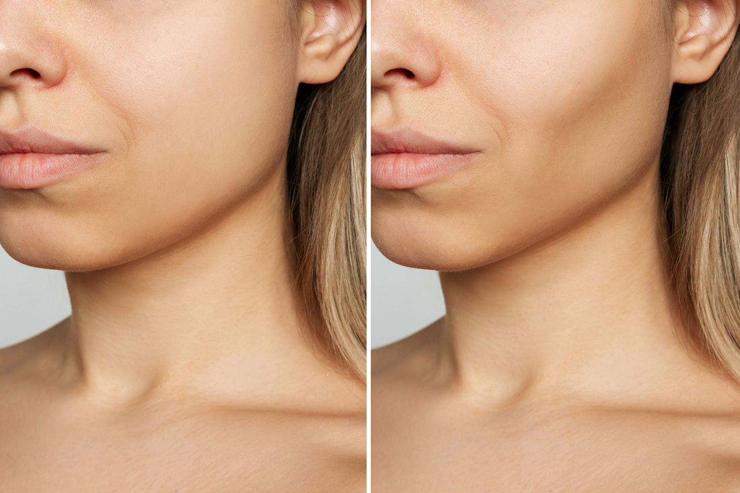 Make sunken cheeks Before & after Treatment images in South Jordan, UT | SkinLumi Aesthetics