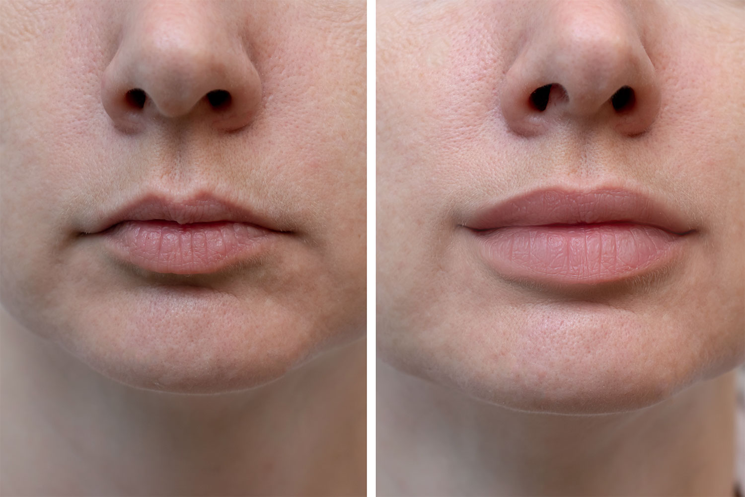 Plump and enhance the lips Before & after Treatment images in South Jordan, UT | SkinLumi Aesthetics