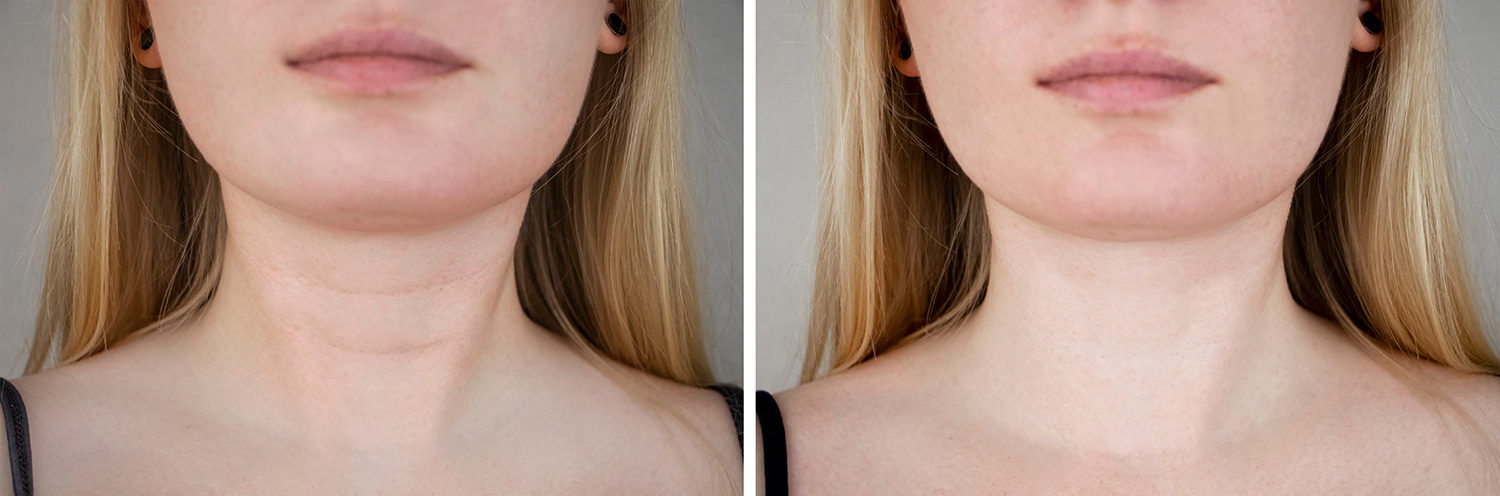 Remove chin creases Before & after Treatment images in South Jordan, UT | SkinLumi Aesthetics