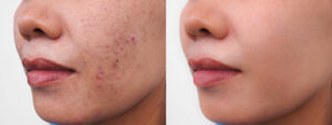 Acne Before & after Treatment images in South Jordan, UT | SkinLumi Aesthetics