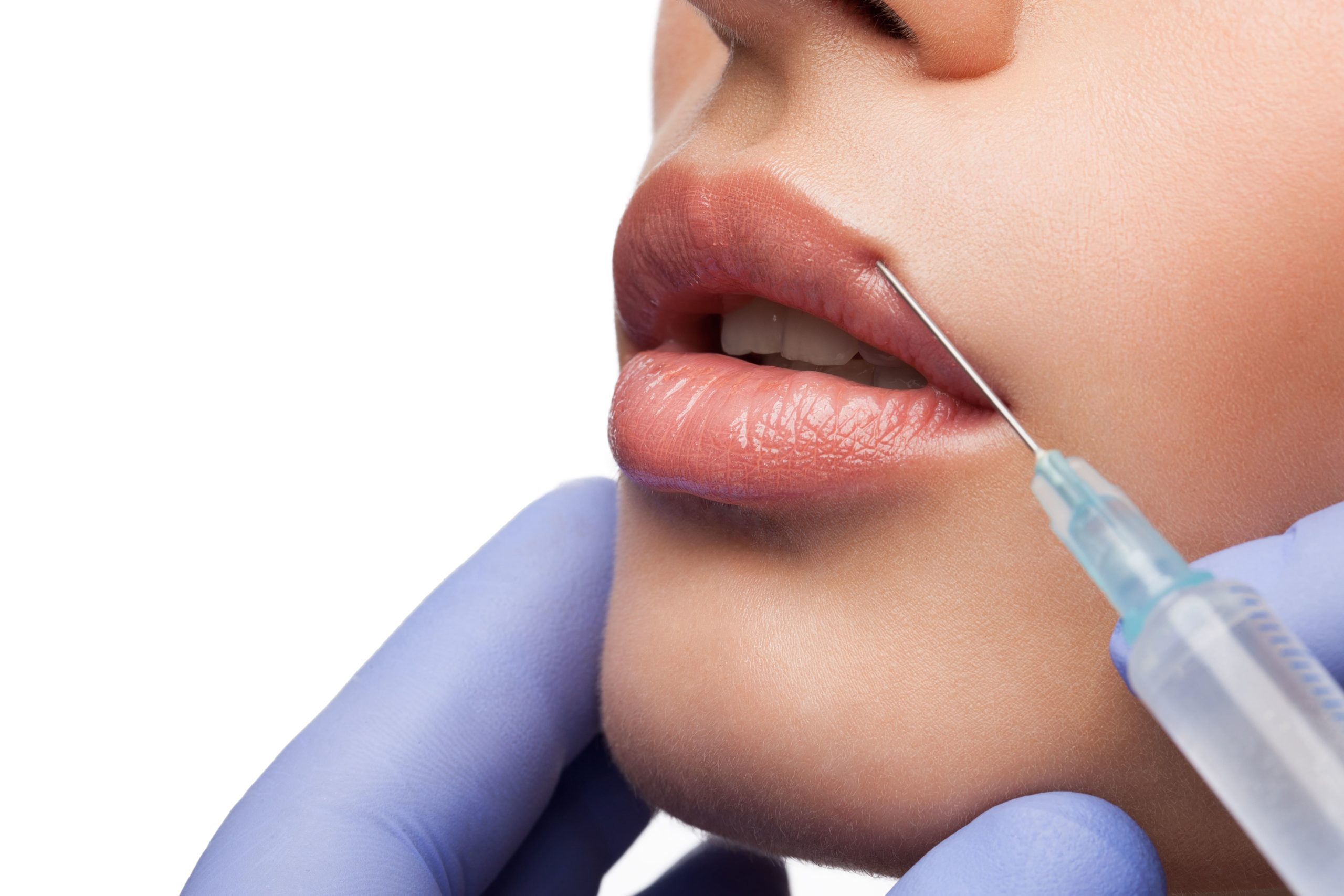 Dermal Fillers Treatment in South Jordan, UT | SkinLumi Aesthetics