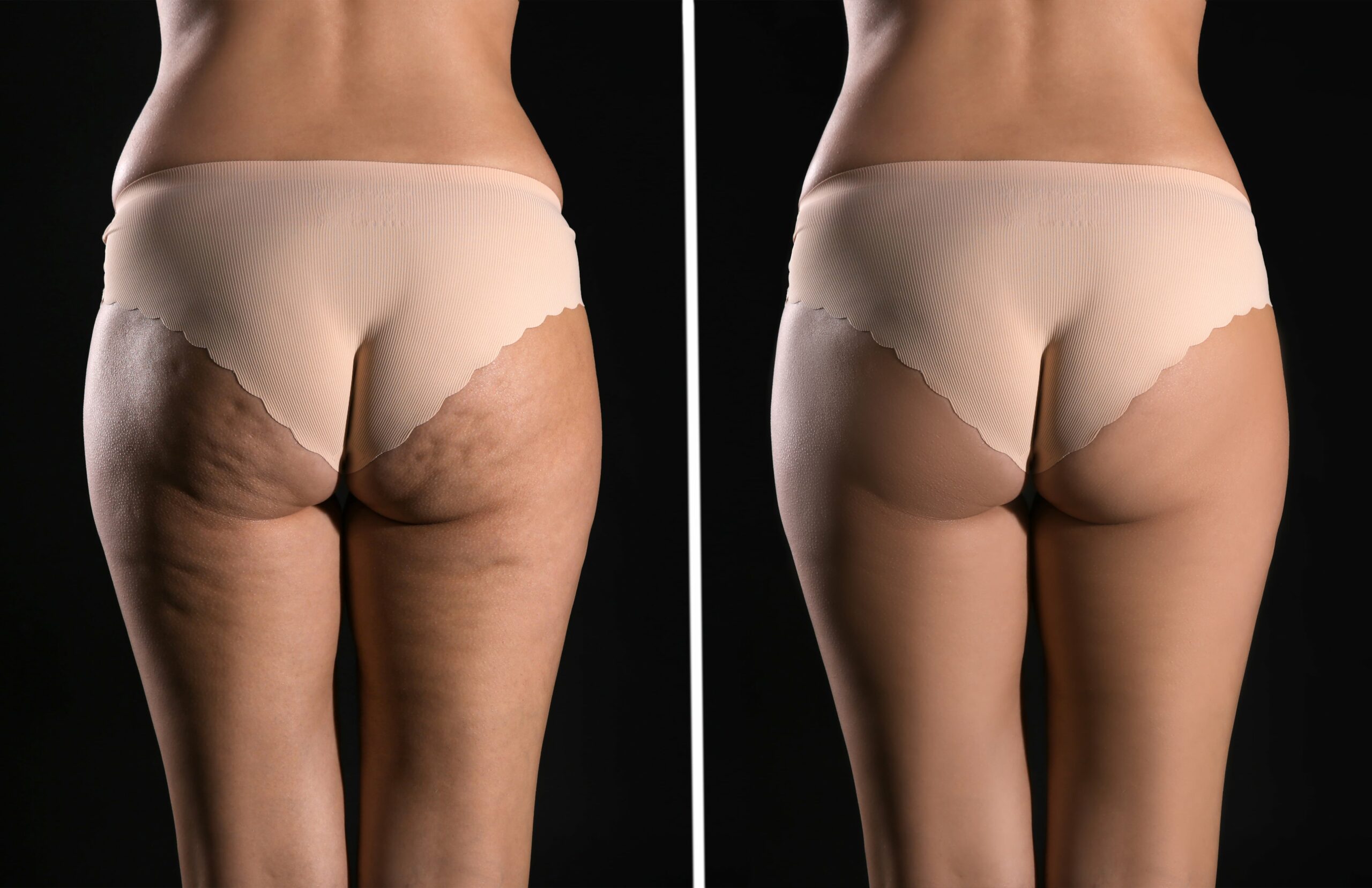 Cellulite Treatment in South Jordan, UT | SkinLumi Aesthetics